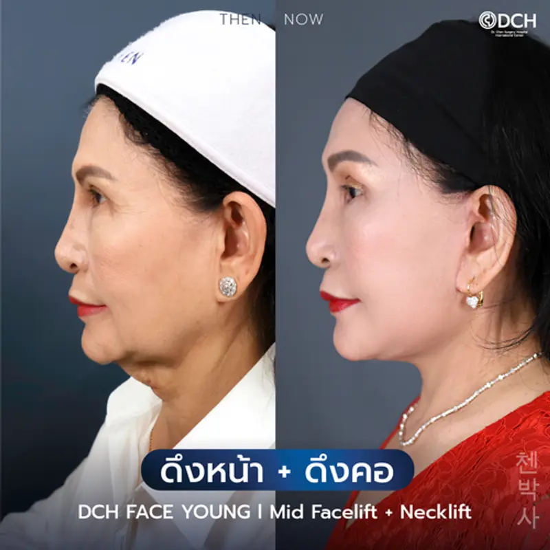 รีวิวศัลยกรรมดึงหน้า