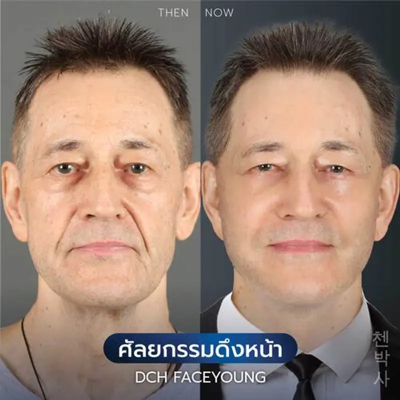 รีวิวศัลยกรรมดึงหน้า