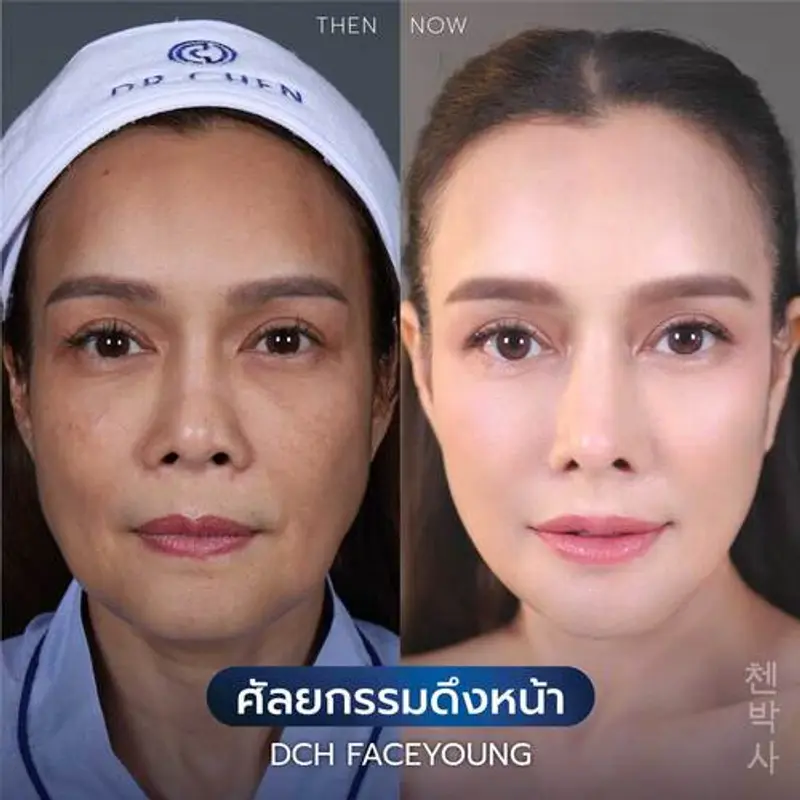 รีวิวศัลยกรรมดึงหน้า