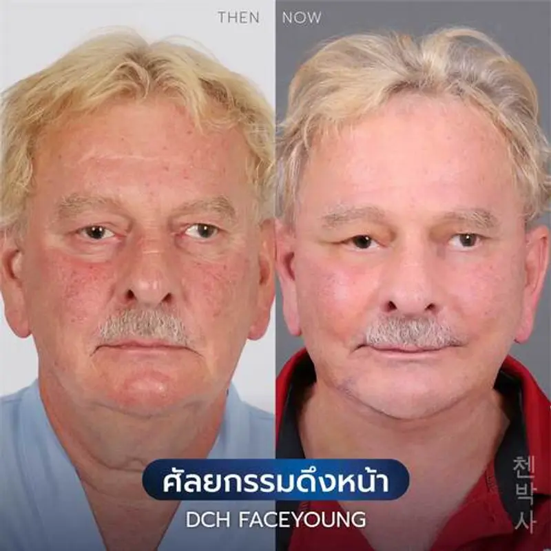รีวิวศัลยกรรมดึงหน้า