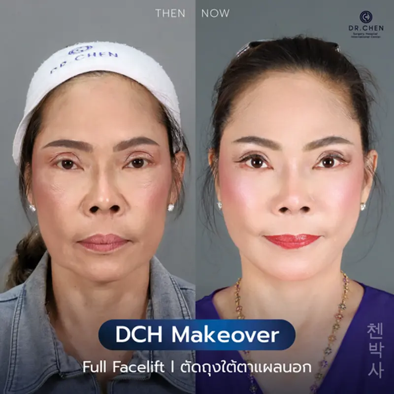 รีวิวศัลยกรรมดึงหน้า