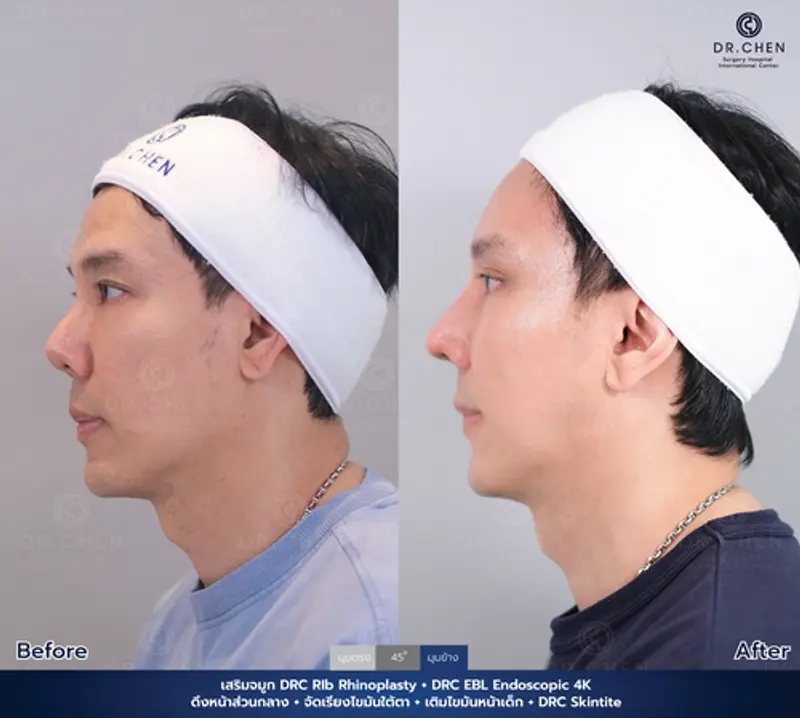 รีวิวศัลยกรรมดึงหน้า