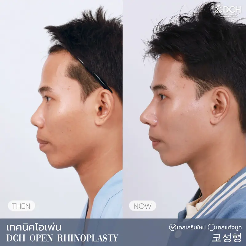 ศัลยกรรมจมูก