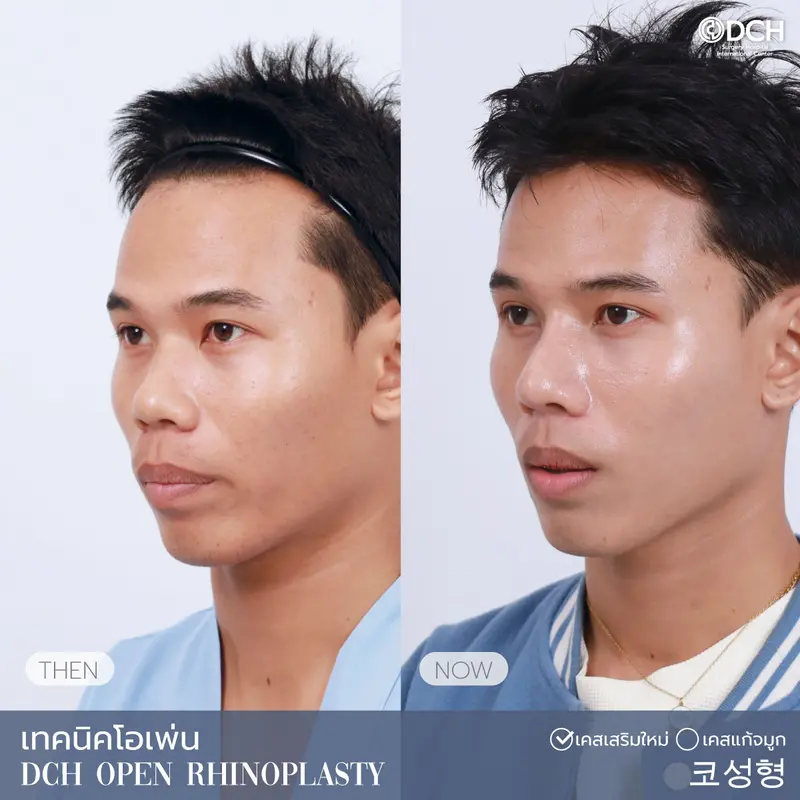 ศัลยกรรมจมูกผู้ชาย