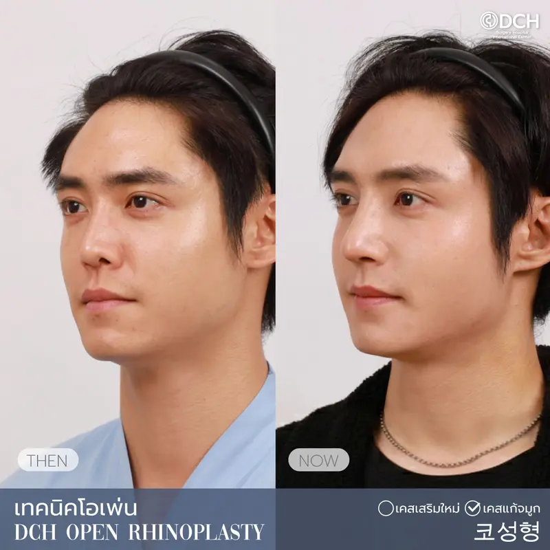 ศัลยกรรมจมูกผู้ชาย