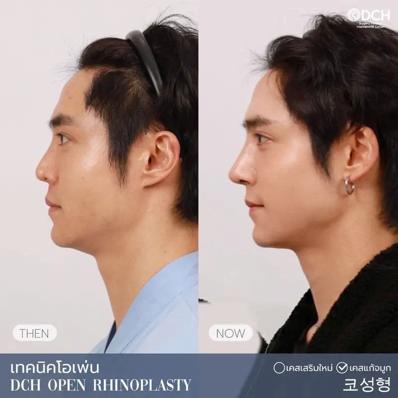 ศัลยกรรมจมูก