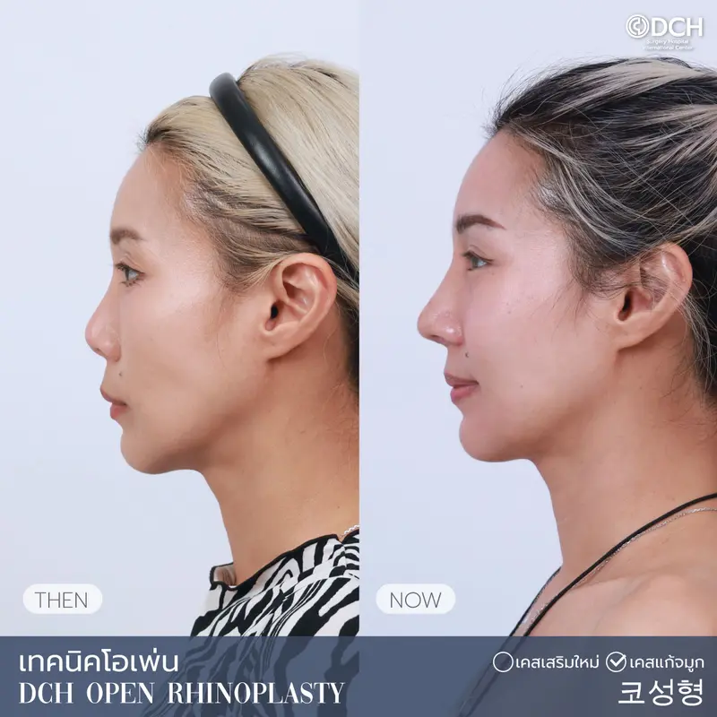 ศัลยกรรมจมูกผู้หญิง