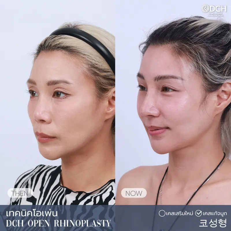 ศัลยกรรมจมูกผู้หญิง