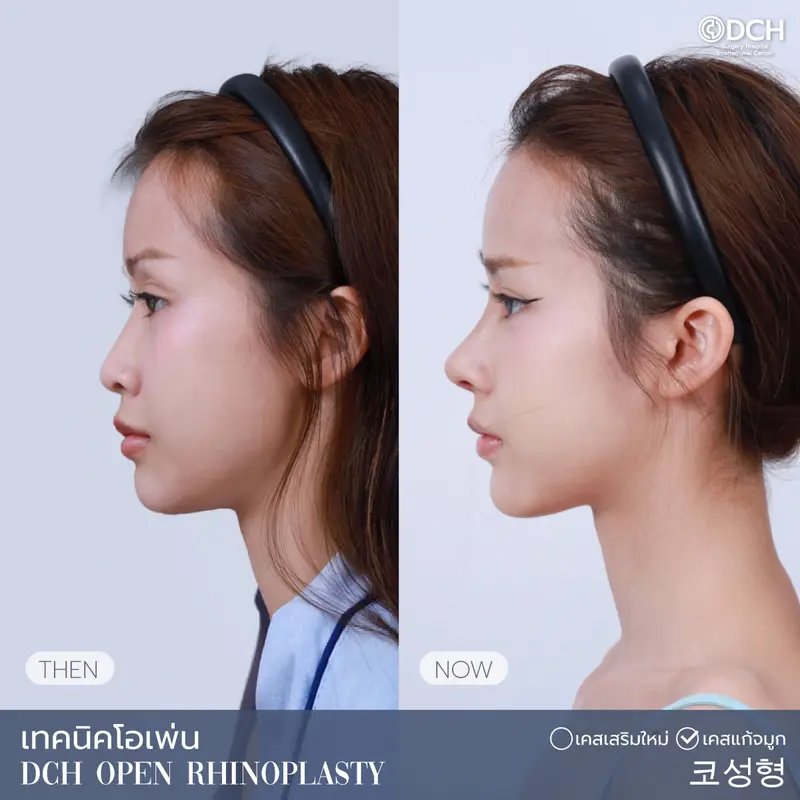 ศัลยกรรมจมูกผู้หญิง