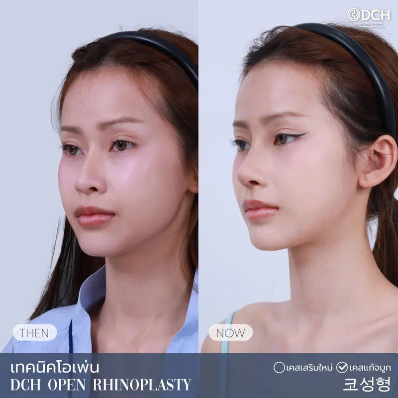 ศัลยกรรมจมูกผู้หญิง