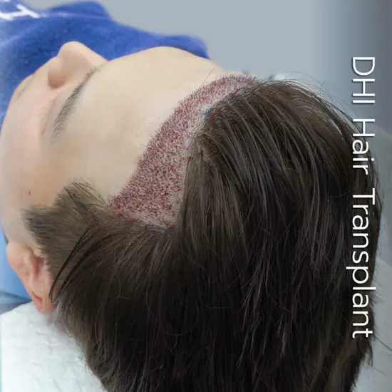 ปลูกผมถาวร