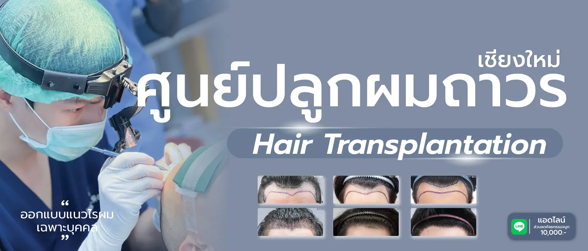 ปลูกผมเชียงใหม่