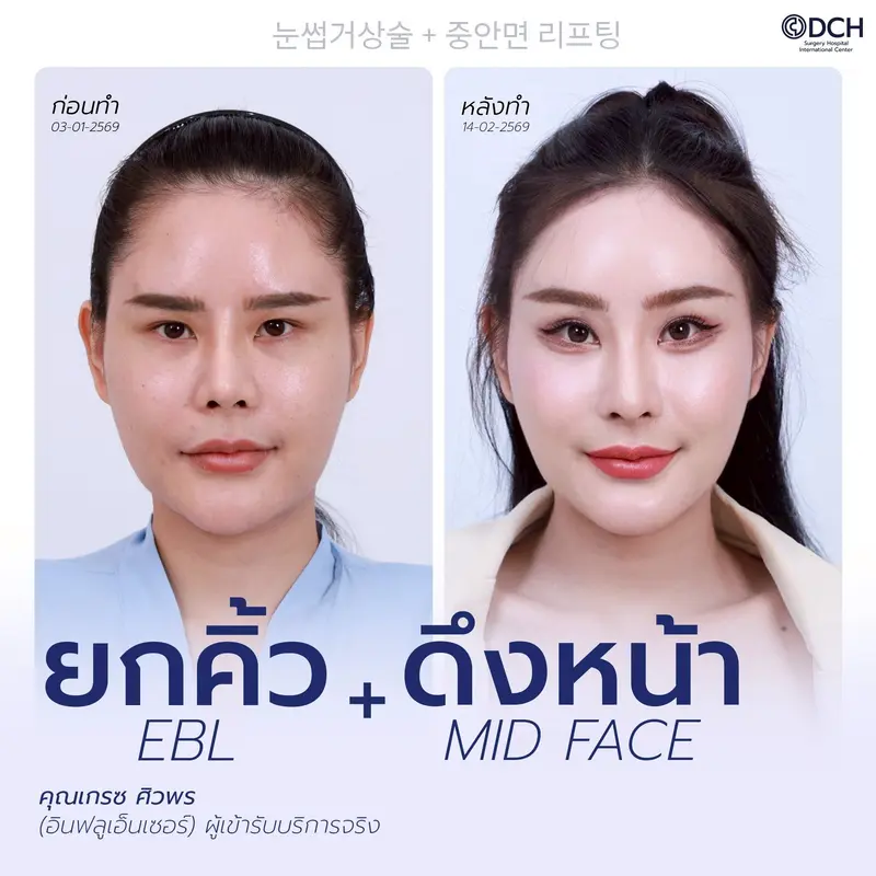 รีวิวยกคิ้ว EBL + ดึงหน้า Mid Face ก่อนหลัง คุณเกรซ