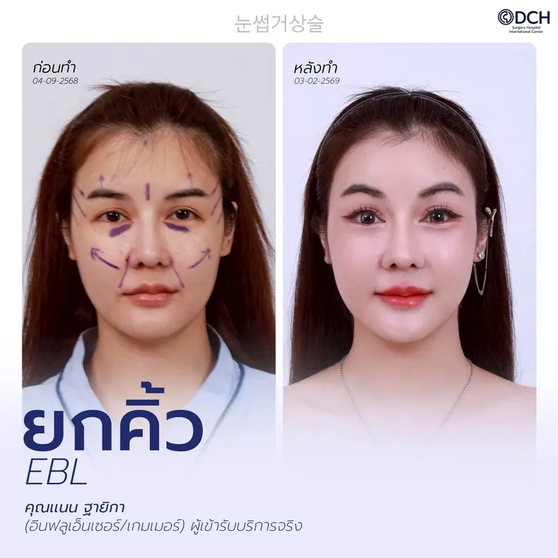 ผลลัพธ์ยกคิ้ว EBL ยกหางตา
