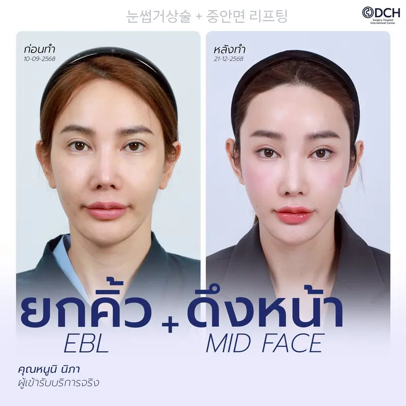 รีวิวยกคิ้ว EBL และดึงหน้า Mid Face ก่อนหลัง