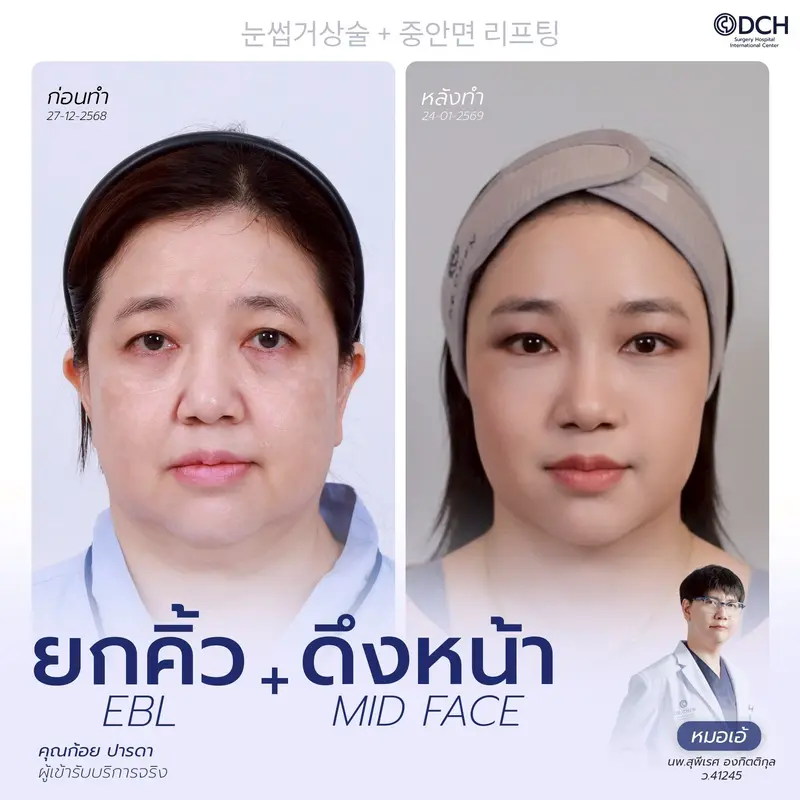 ก่อนหลัง ยกคิ้ว EBL + Mid Face Lift