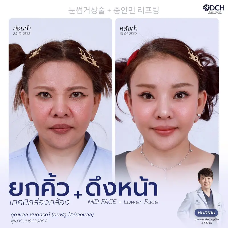 รีวิว Endotine Brow Lift + Mid Face Lift