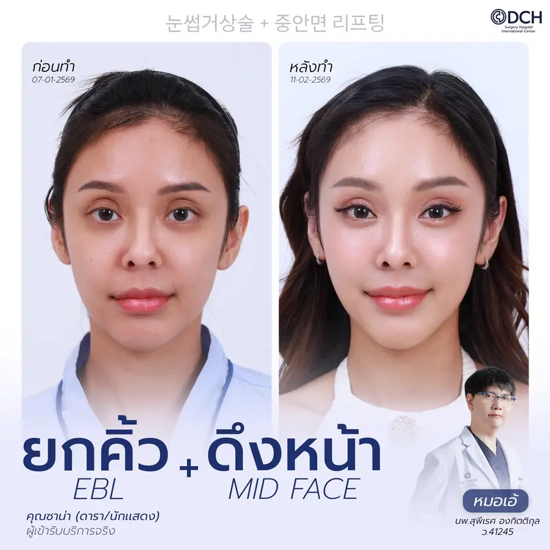 ผลลัพธ์ยกคิ้ว Endotine พร้อม Midface Lift