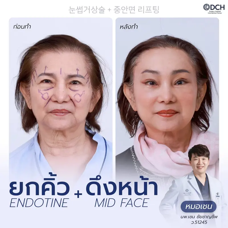ก่อนหลัง ยกคิ้ว Endotine และดึงหน้า Mid Face
