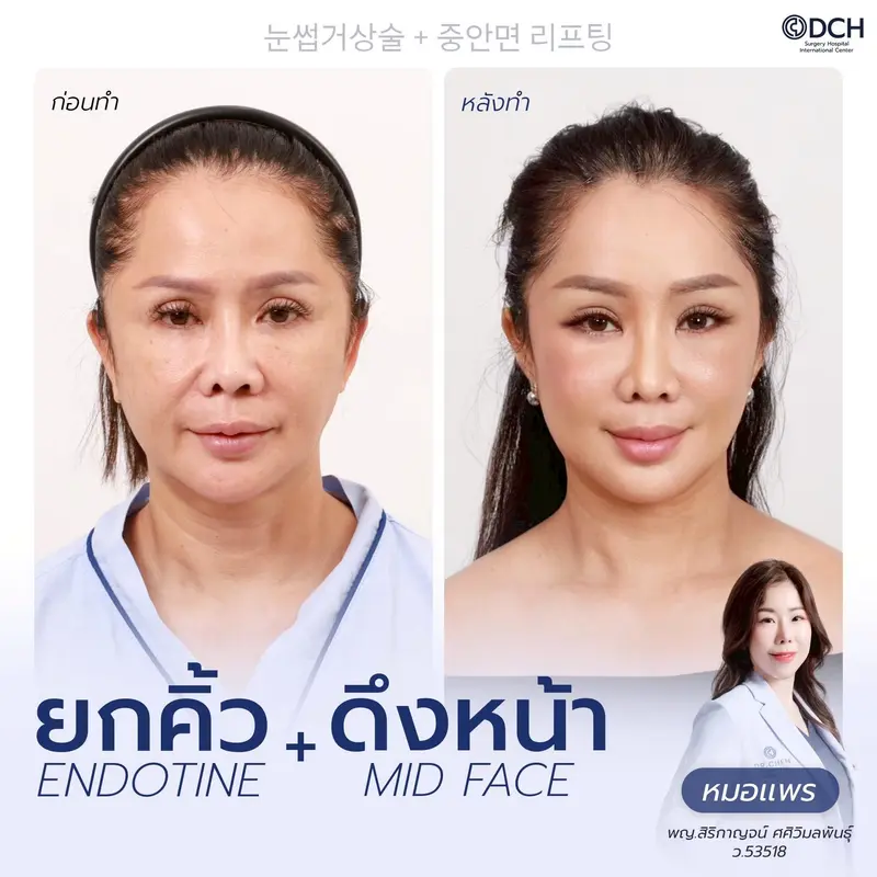 ก่อนหลัง ยกคิ้ว EBL + Mid Face Lift