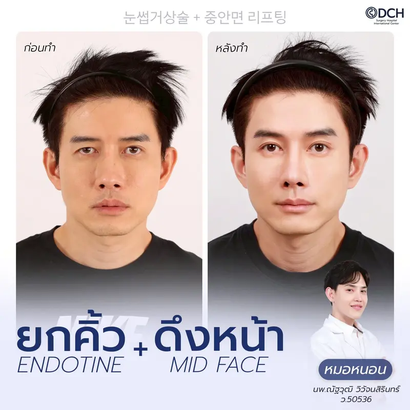 ผลลัพธ์ยกคิ้ว EBL พร้อมดึงหน้า Mid Face