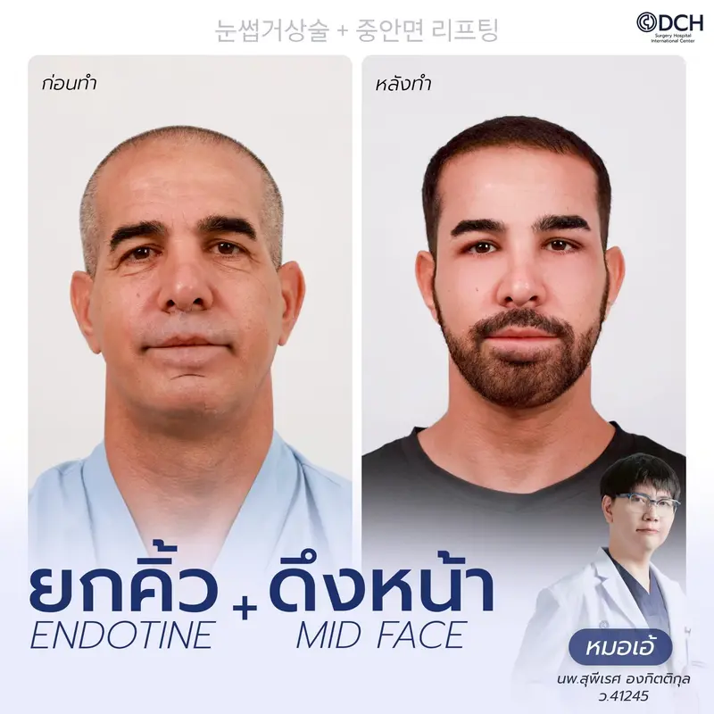 รีวิว Endotine Brow Lift + Mid Face Lift