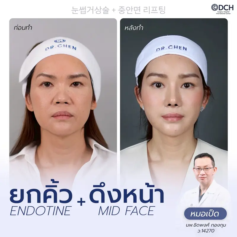 รีวิว Endotine Brow Lift + Mid Face Lift