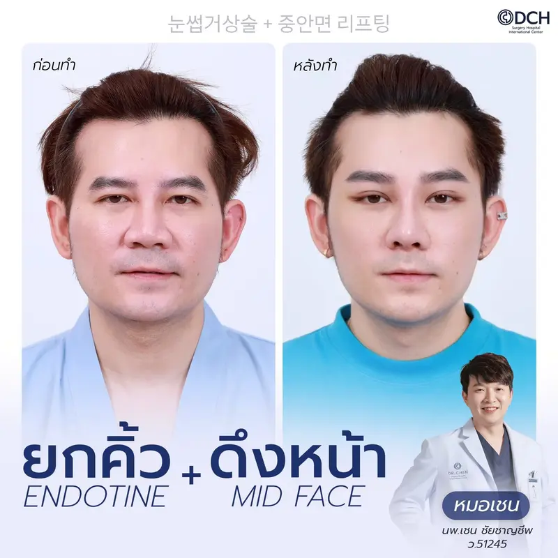 ก่อนหลัง ยกคิ้ว Endotine และดึงหน้า Mid Face