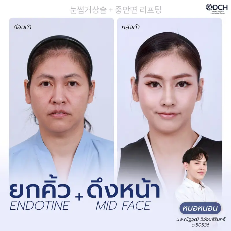 ผลลัพธ์ยกคิ้ว Endotine พร้อม Midface Lift