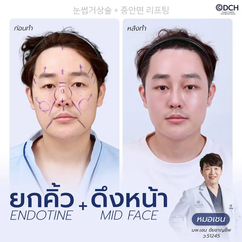 รีวิว Endotine Brow Lift + Mid Face Lift