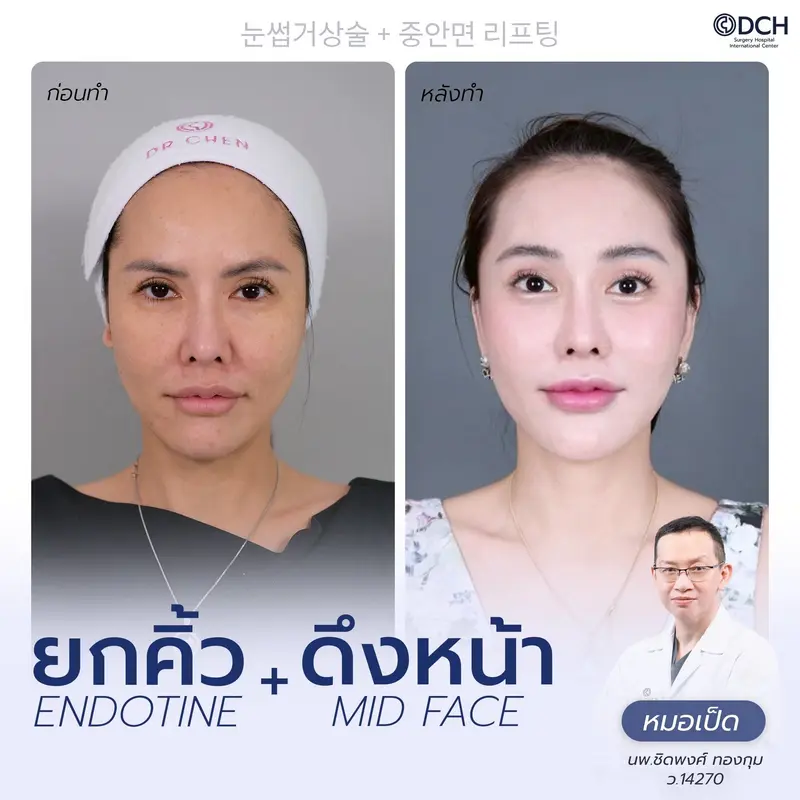 รีวิว Endotine Brow Lift + Mid Face Lift