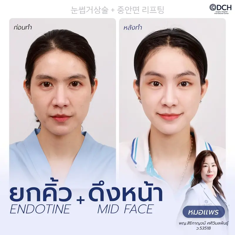 ผลลัพธ์ยกคิ้ว Endotine พร้อม Midface Lift