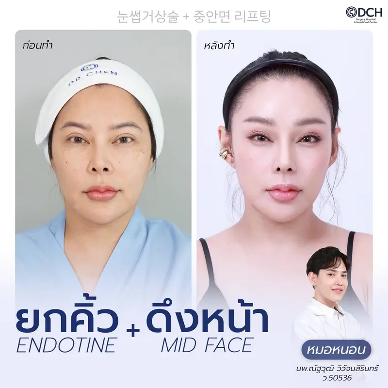 ผลลัพธ์ยกคิ้ว Endotine พร้อม Midface Lift
