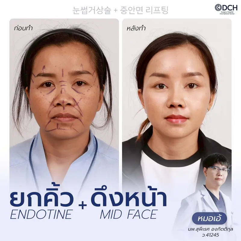 ก่อนหลัง ยกคิ้ว Endotine และดึงหน้า Mid Face