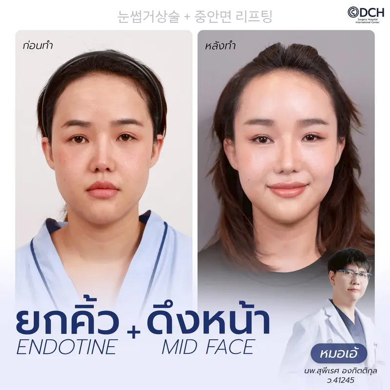 รีวิว Endotine Brow Lift + Mid Face Lift
