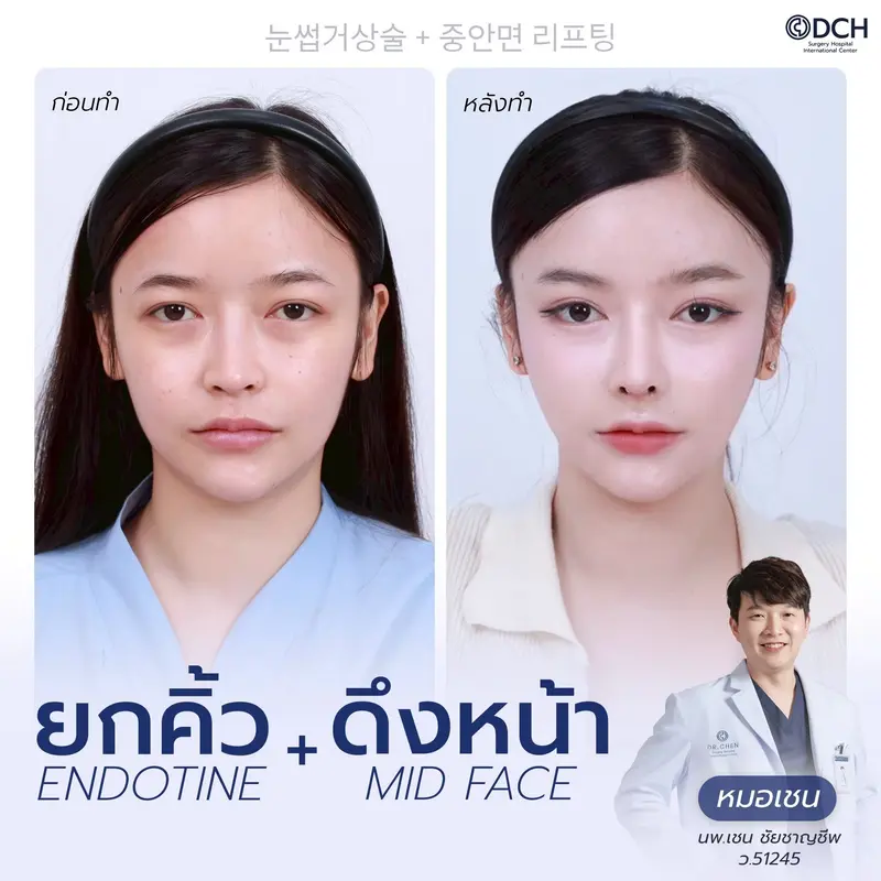 ผลลัพธ์ยกคิ้ว Endotine พร้อม Midface Lift