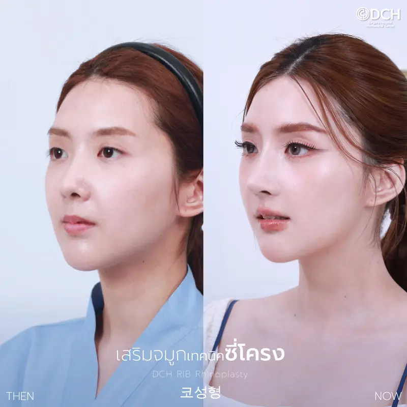 เบียร์ The Voice เสริมจมูก