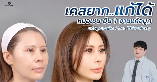 เคสยากแก้ได้ ‼️‼️❤️ แก้จมูกปรับโครงสร้าง ด้วยเทคนิค  DRC Open Rhinoplasty ที่ Dr. Chen Clinic 