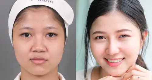 😍 เสริมใหม่ สวยไม่ไหวแล้ว ‼️‼️