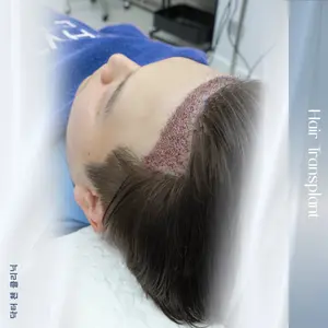 ปลูกผมถาวร