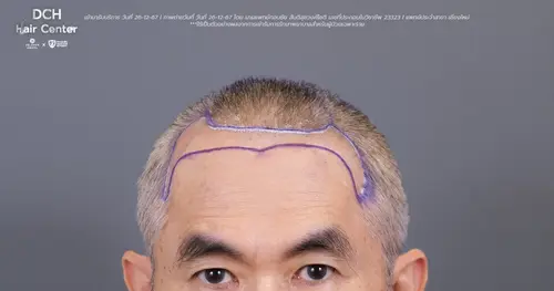 รีวิวปลูกผมถาวรที่ DCH Hair Center เติมผมที่หาย เติมความมั่นใจให้เกินร้อย