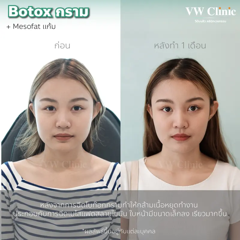 ฺBotox กราม
