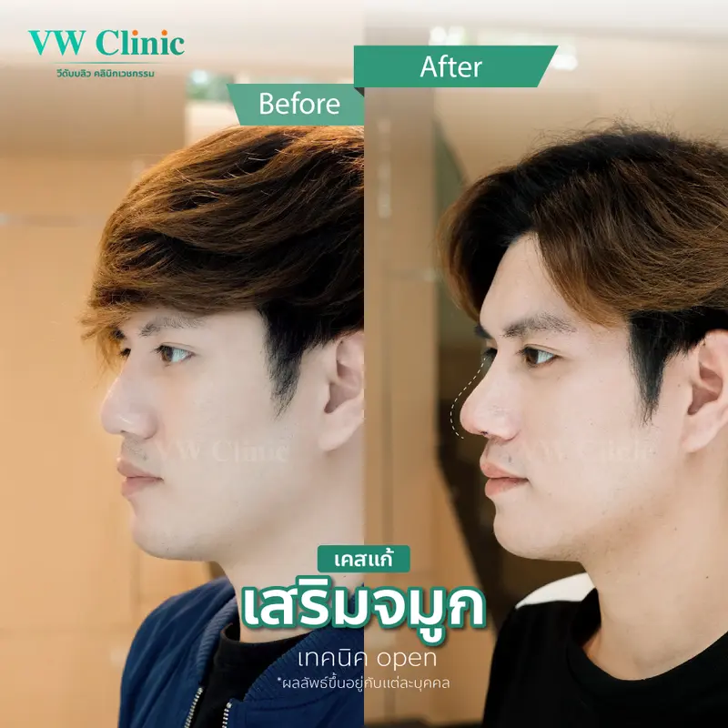 เสริมจมูก