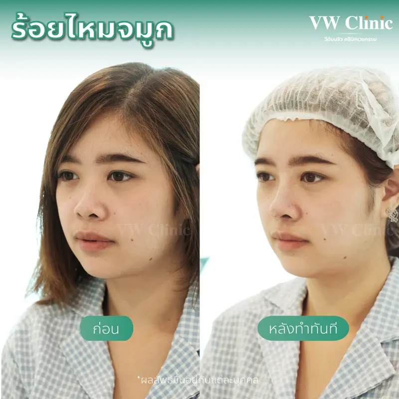 ร้อยไหมจมูก