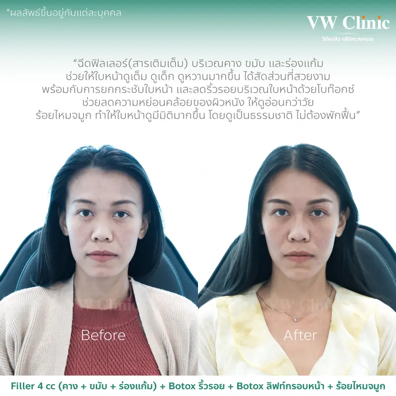 Filler + Botox + MesoFat