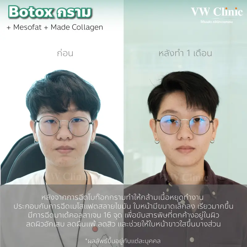 Botox กราม