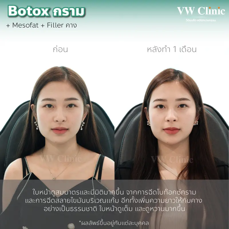 Filler + Botox + MesoFat