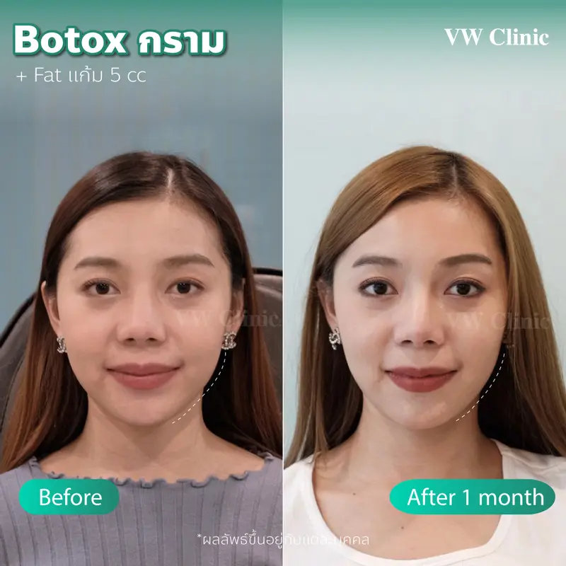 Botox กราม