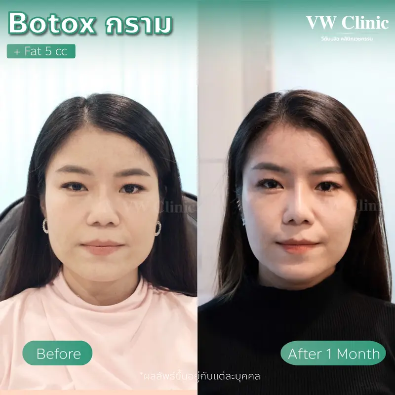 Botox กราม