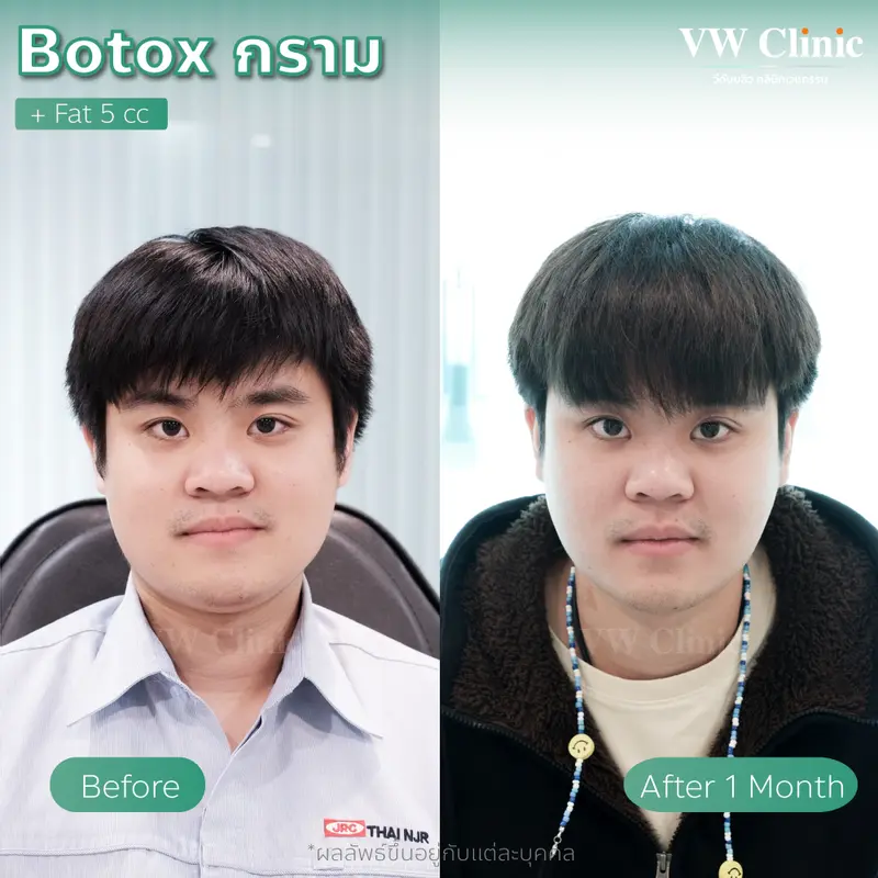 Botox กราม